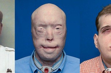 El mayor trasplante de rostro de la historia