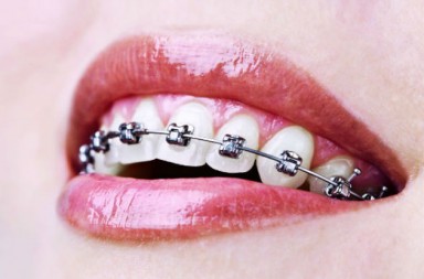Los ‘brackets’ no son cosa de niños
