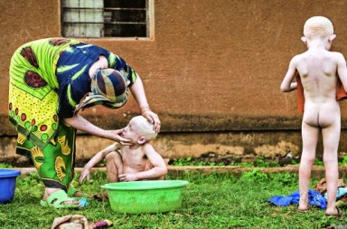 Albinos, un blanco fácil para muchos enemigos