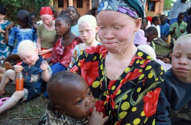 Albinos en África: la maldición de los niños ‘blancos’