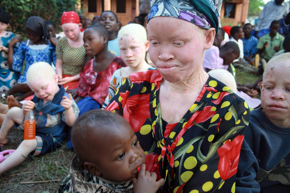 Albinos en África: la maldición de los niños 'blancos', image size:1200x800