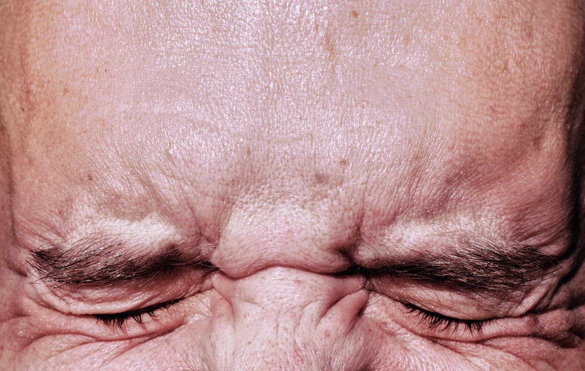 conocer, migrañas, cefaleas, xlsemanal