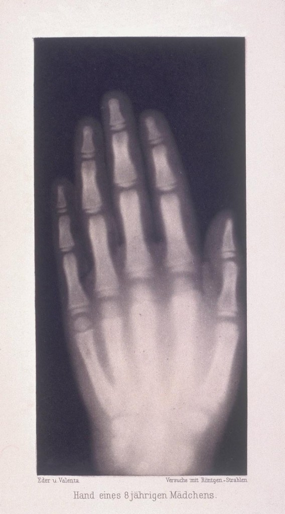 Una de las primeras radiografias realizadas por Wilhelm Conrad Rontgen Hand of an eight year old girl, 1896. A photogravure taken from the original x-ray. In 1895, as Professor of Physics at the University of Wurzburg, Wilhelm Conrad Rontgen was experimenting with a Crookes' radiometer (cathode ray tubes), invented in 1875. He noticed that when cathode rays struck the end of a discharge tube, rays of a new kind were emitted, capable of penetrating matter. On 22 December 1895 he took the first x-ray, an image of the ringed hand of his wife Bertha. He was awarded the first Nobel Prize for physics in 1901. Hand of an eight year old girl, 1896.