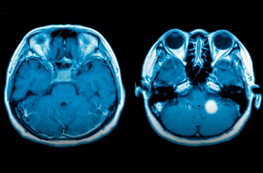 El gadolinio, clave para detectar tumores cerebrales, podría ser tóxico