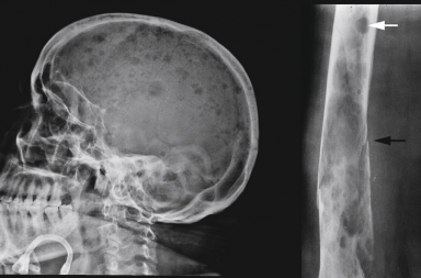 Mieloma múltiple: el cáncer invisible