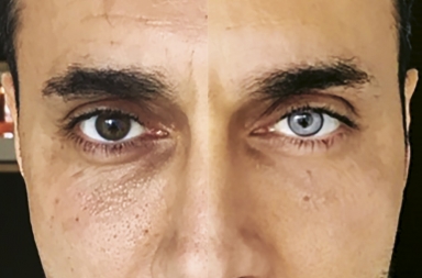 La nueva moda: operarse para tener los ojos azules