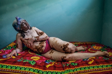 Vitíligo, una enfermedad que deja secuelas más allá de la piel